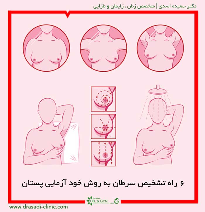 ۶ راه تشخیص سرطان سینه از طریق خود آزمایی پستان | دکتر سعیده اسدی٬ متخصص زنان در شرق تهران ۶ راه تشخیص سرطان سینه از طریق خود آزمایی پستان | دکتر سعیده اسدی٬ متخصص زنان در شرق تهران