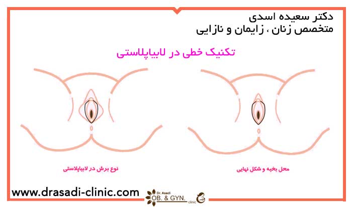 عکس عمل لابیاپلاستی | متخصص زنان در شرق تهران٬ دکتر سعیده اسدی عکس عمل لابیاپلاستی | متخصص زنان در شرق تهران٬ دکتر سعیده اسدی