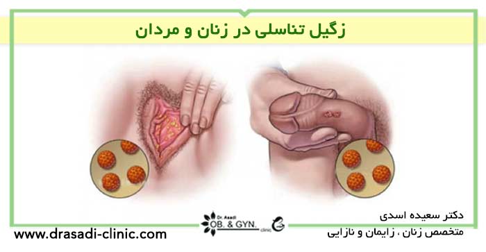 زگیل تناسلی در زنان و مردان | دکتر سعیده اسدی٬ متخصص زنان در شرق تهران زگیل تناسلی در زنان و مردان | دکتر سعیده اسدی٬ متخصص زنان در شرق تهران