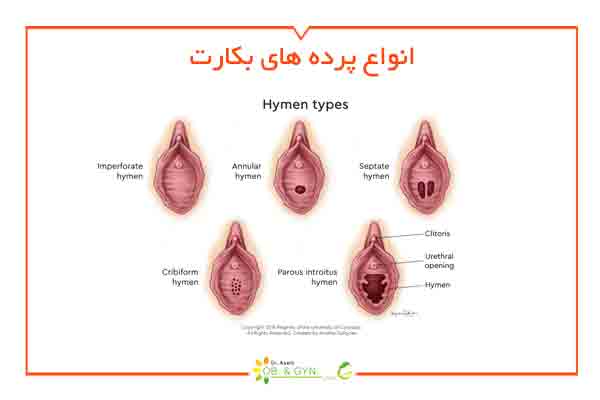 انواع پرده بکارت - دکتر سعیده اسدی انواع پرده بکارت - دکتر سعیده اسدی
