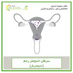 endometrail sh 150x150 - سرطان تخمدان چیست؟ علائم و درمان آن