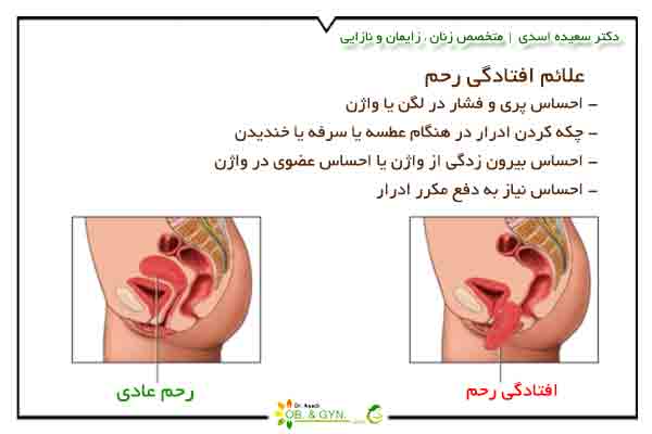 علائم افتادگی رحم چیست؟ | دکتر سعیده اسدی٬ متخصص زنان علائم افتادگی رحم چیست؟ | دکتر سعیده اسدی٬ متخصص زنان