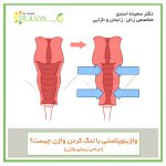vaginoplasty sh drasadi 150x150 - معایب و عوارض عمل لابیاپلاستی چیست؟