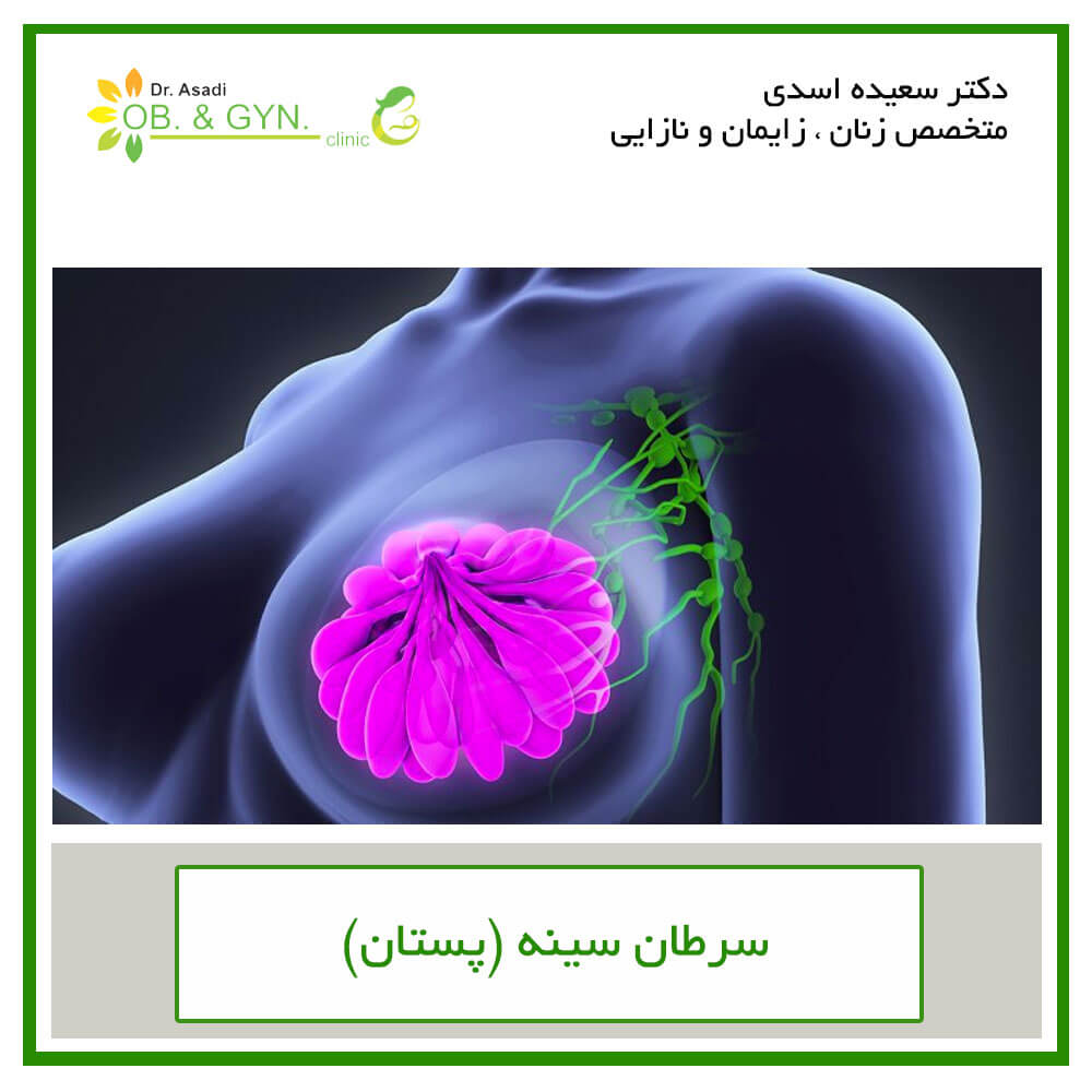 سرطان سینه (پستان) | علائم و درمان | دکتر سعیده اسدی٬ متخصص زنان