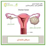 ovarian cancer drasadi sh 150x150 - علائم سرطان اندومتر (رحم) چیست؟