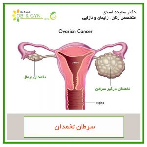 سرطان تخمدان - دکتر سعیده اسدی٬ متخصص زنان