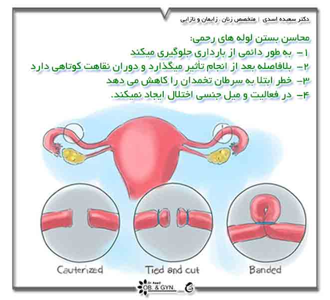Blocked fallopian tubes m - توبکتومی چیست؛ مزایا و معایب عمل بستن لوله رحم
