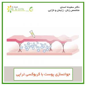 جوانسازی واژن با کربوکسی تراپی|دکتر سعیده اسدی٬ متخصص زنان