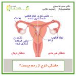 ectopic pregnancy shh 150x150 - علت درد لگن در زنان چیست؟