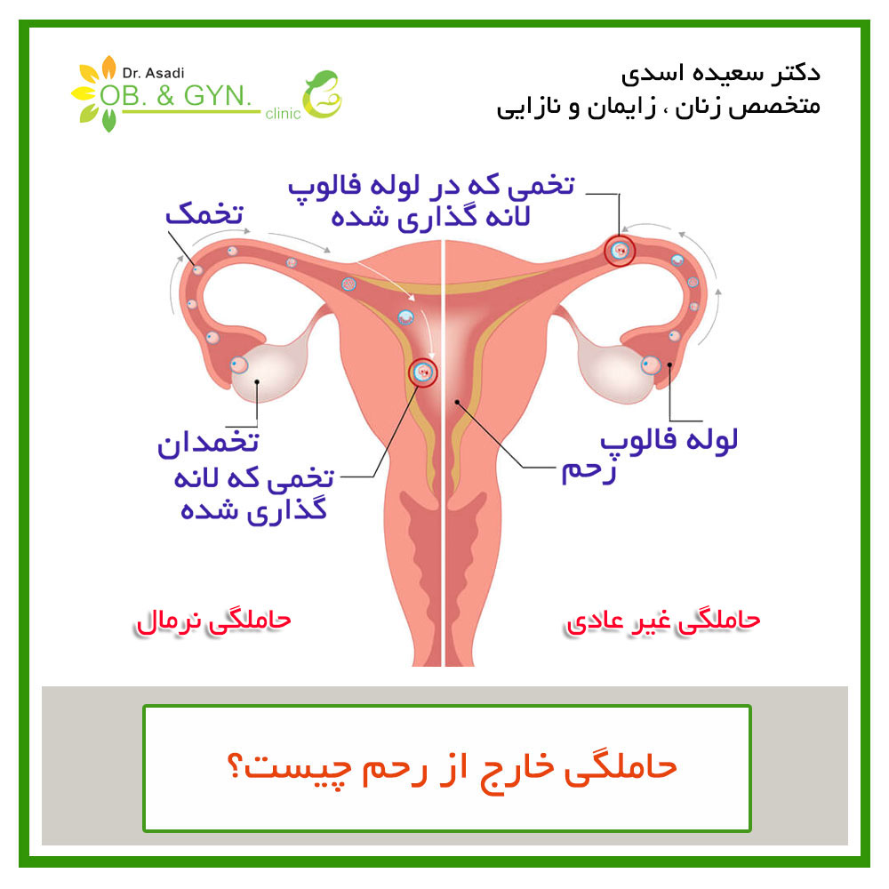 علت حاملگی خارج از رحم | دکتر سعیده اسدی٬ متخصص زنان