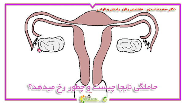 بارداری خارج از رحم چیست | دکتر سعیده اسدی٬ متخصص زنان بارداری خارج از رحم چیست | دکتر سعیده اسدی٬ متخصص زنان