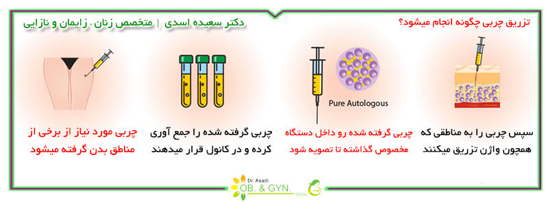 جوانسازی واژن | تزریق چربی به واژن | دکتر سعیده اسدی٬ متخصص زنان جوانسازی واژن | تزریق چربی به واژن | دکتر سعیده اسدی٬ متخصص زنان