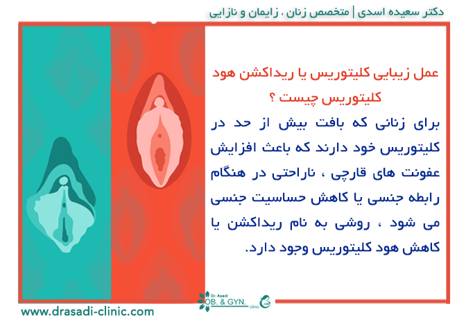 عمل زیبایی کلیتوریس یا ریداکشن کلیتوریس | متخصص زنان در شرق تهران٬ دکتر سعیده اسدی عمل زیبایی کلیتوریس یا ریداکشن کلیتوریس | متخصص زنان در شرق تهران٬ دکتر سعیده اسدی