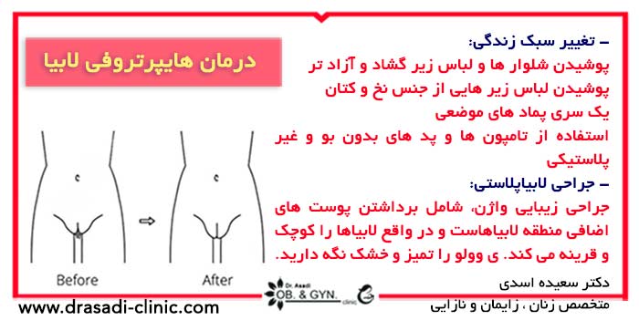 درمان هایپرتوفی (بزرگی لابیا) | دکتر سعیده اسدی٬ متخصص زنان در شرق تهران درمان هایپرتوفی (بزرگی لابیا) | دکتر سعیده اسدی٬ متخصص زنان در شرق تهران