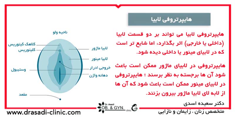 لابیا چیست؟ | دکتر سعیده اسدی٬ متخصص زنان در شرق تهران لابیا چیست؟ | دکتر سعیده اسدی٬ متخصص زنان در شرق تهران