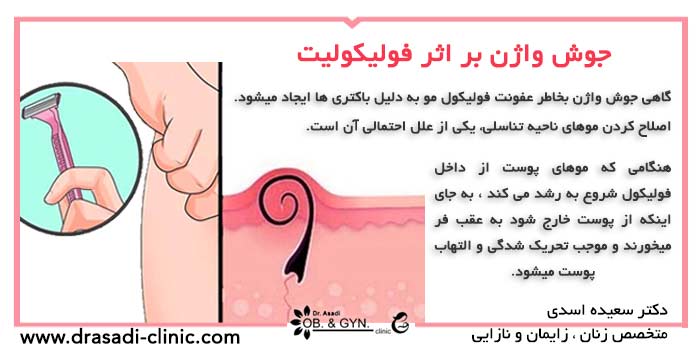 جوش واژن چیست؟ راههای درمان | دکتر سعیده اسدی٬ متخصص زنان در شرق تهران جوش واژن چیست؟ راههای درمان | دکتر سعیده اسدی٬ متخصص زنان در شرق تهران