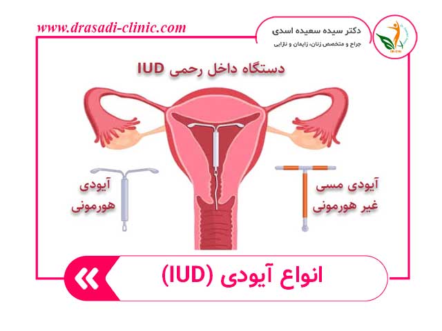 %D8%A7%D9%86%D9%88%D8%A7%D8%B9 %D8%A2%DB%8C%D9%88%D8%AF%DB%8C - آیودی چیست (IUD) و چگونه از بارداری جلوگیری میکند؟