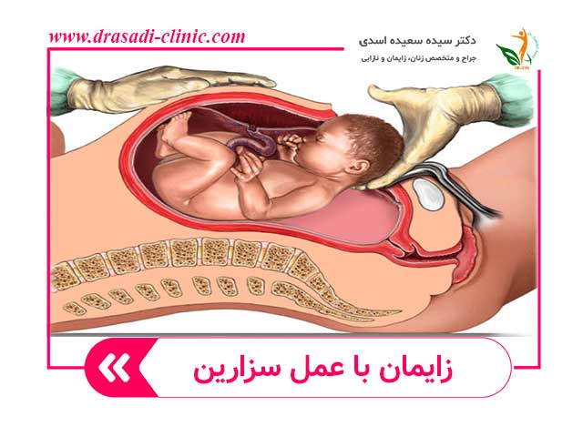 عمل سزارین - دکتر سعیده اسدی متخصص زنان و زایمان