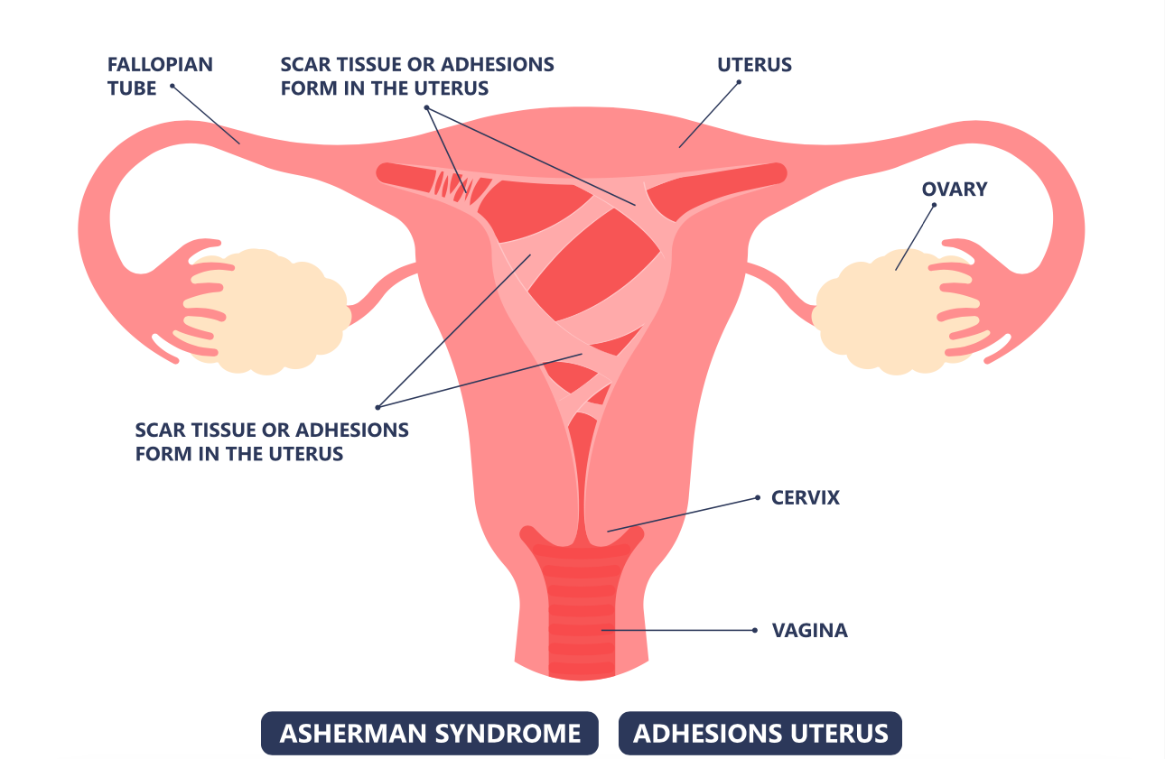 65cb049c76339161bf2464eb Asherman syndrome intrauterine adhesions - چسبندگی رحم یا سندرم آشرمن چیست؟ علائم، علت و درمان آن